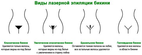 Лазерная эпиляция зоны глубокого бикини - Лазерная эпиляция интимной зоны Киев